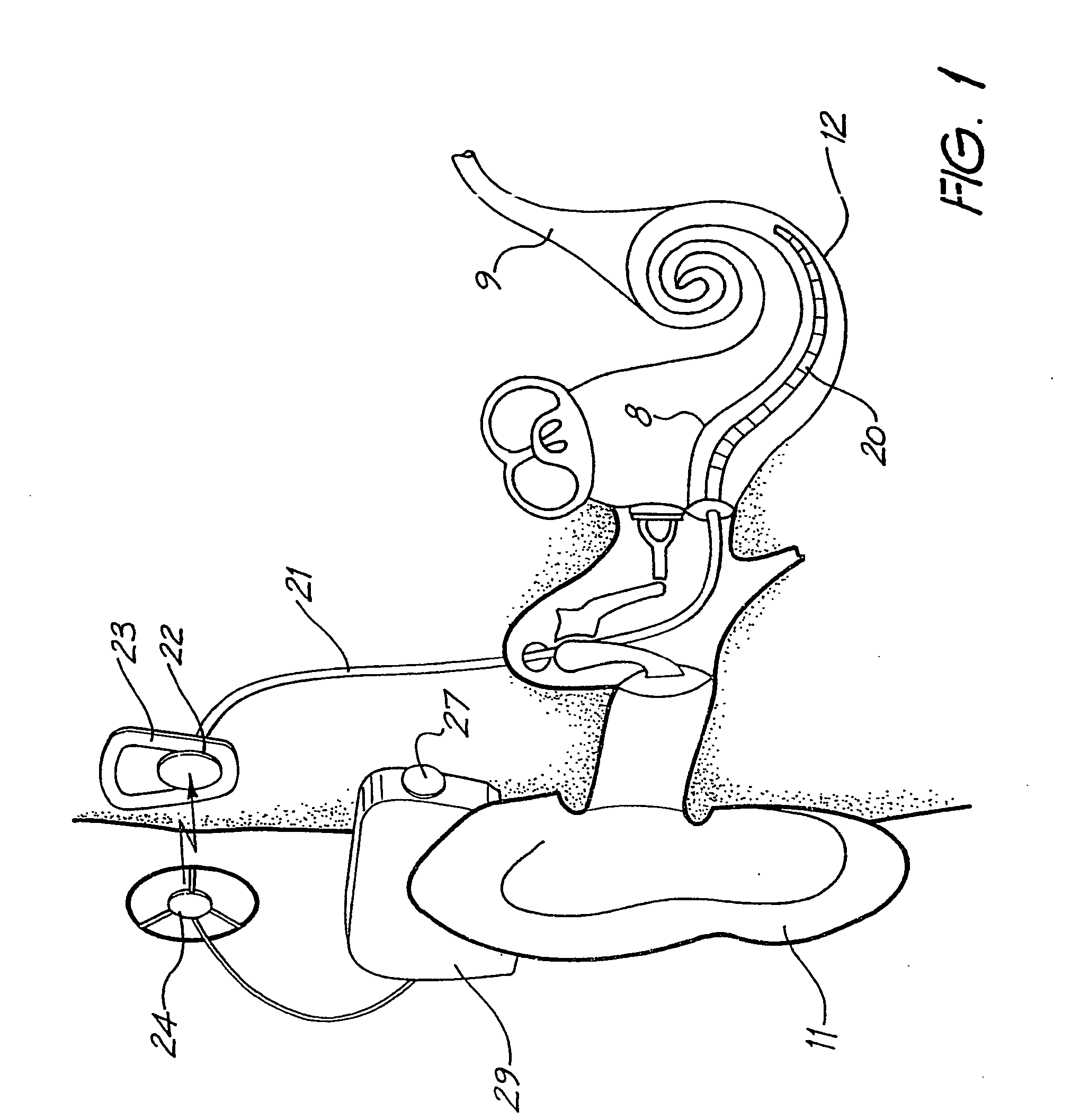 Subthreshold stimulation of a cochlea