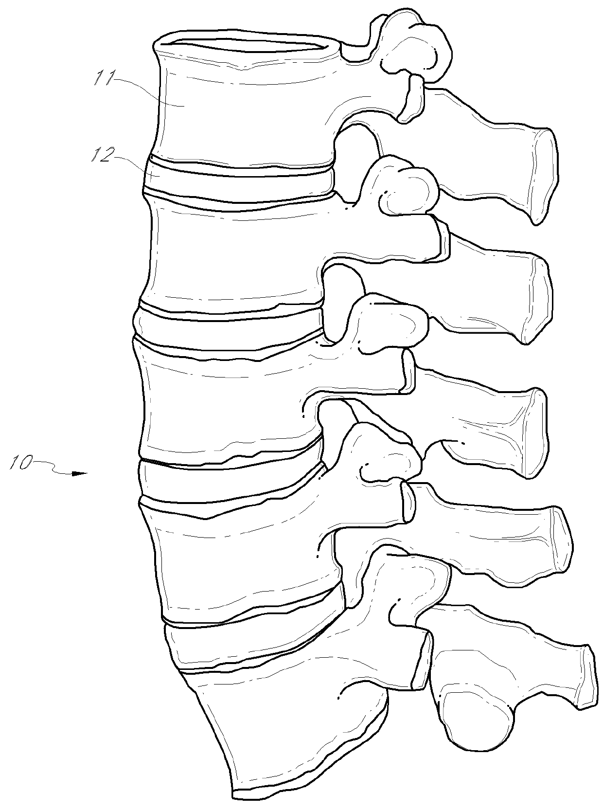 Method and apparatus for minimally invasive insertion of intervertebral implants