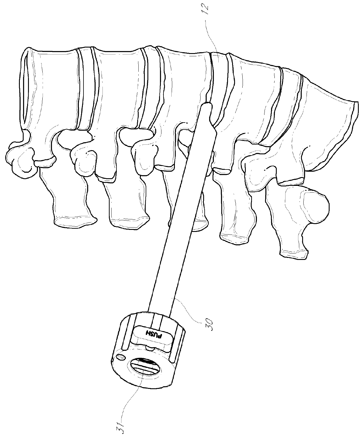 Method and apparatus for minimally invasive insertion of intervertebral implants