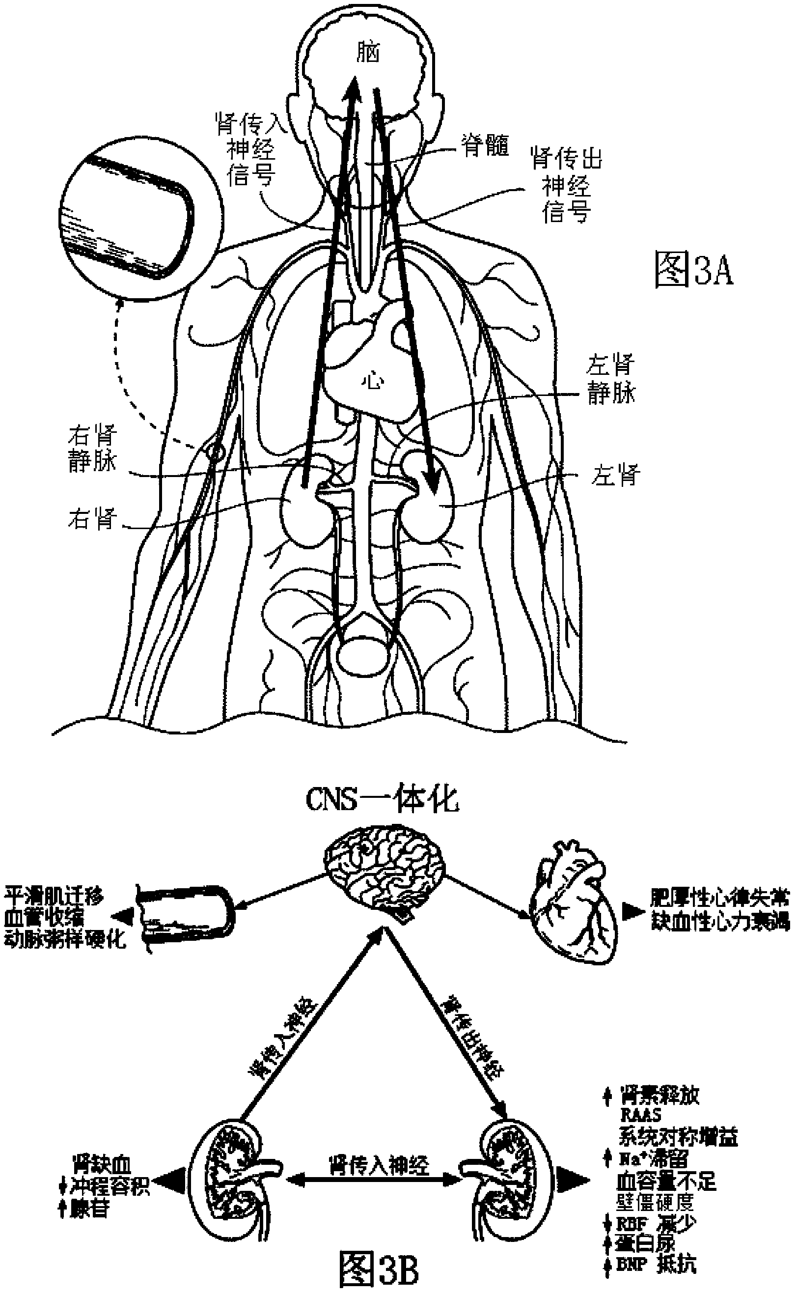 High intensity focused ultrasound apparatuses, systems, and methods for renal neuromodulation