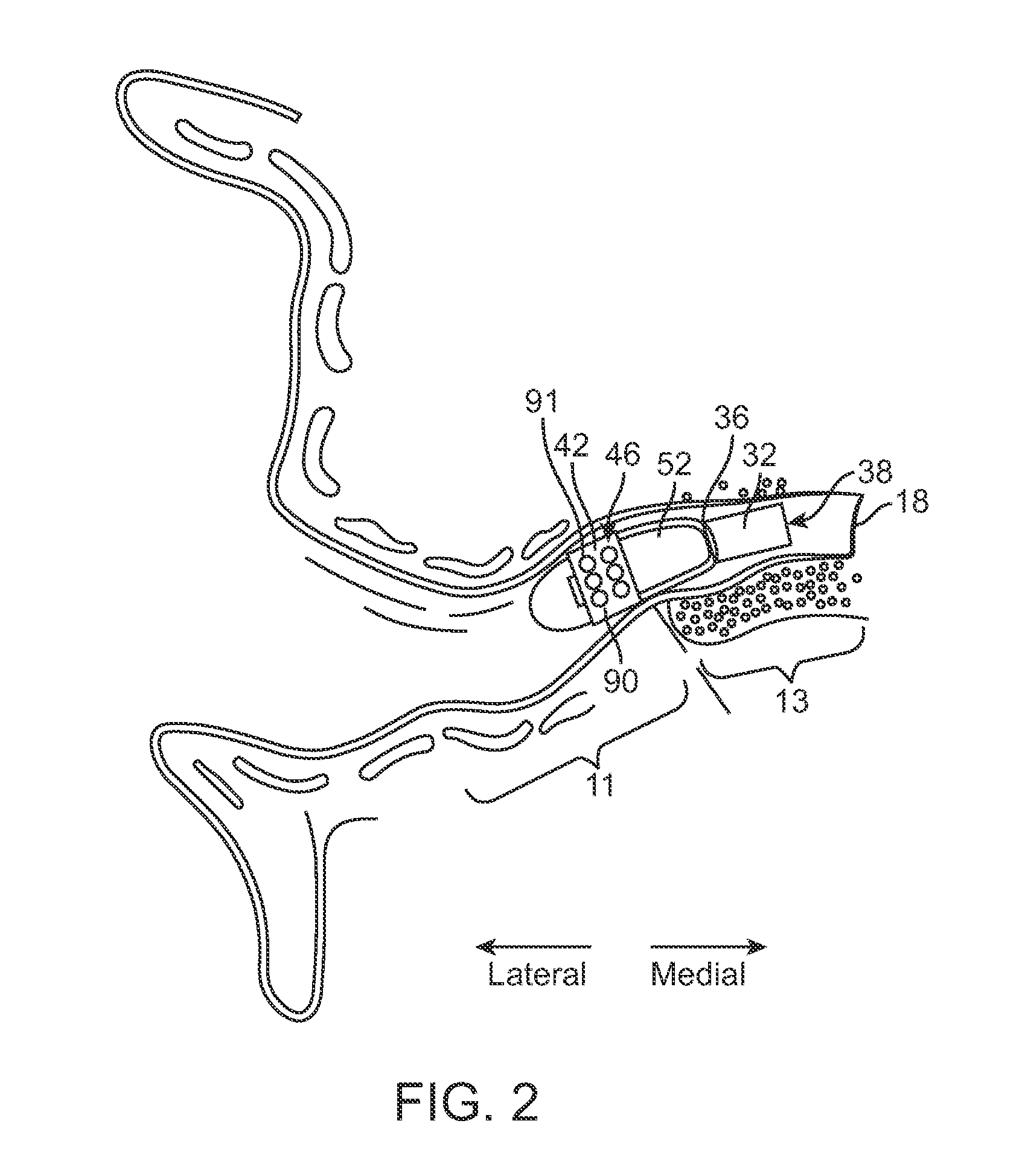 Contamination resistant ports for hearing devices