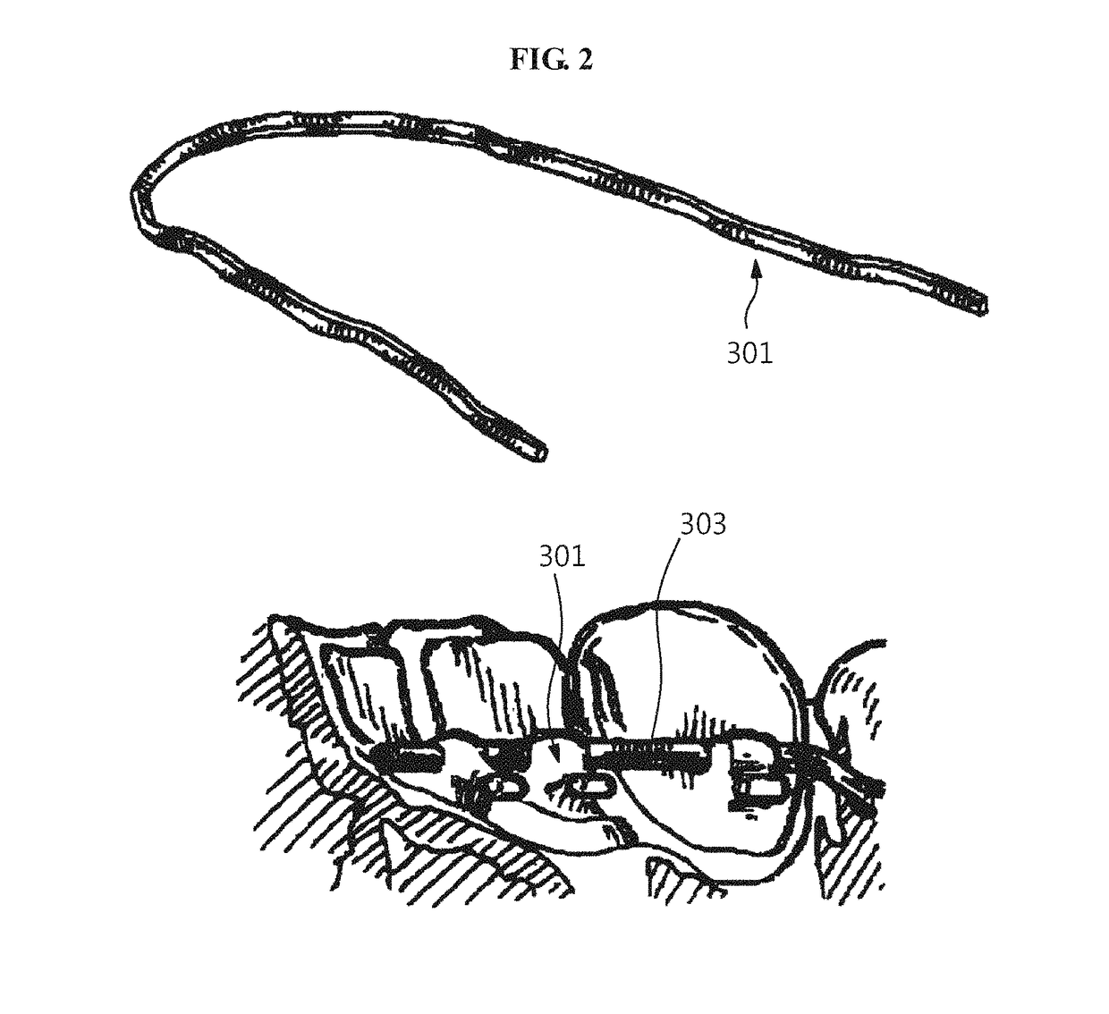 Method of fabricating custom dental correction device, and custom dental correction device fabricated by same