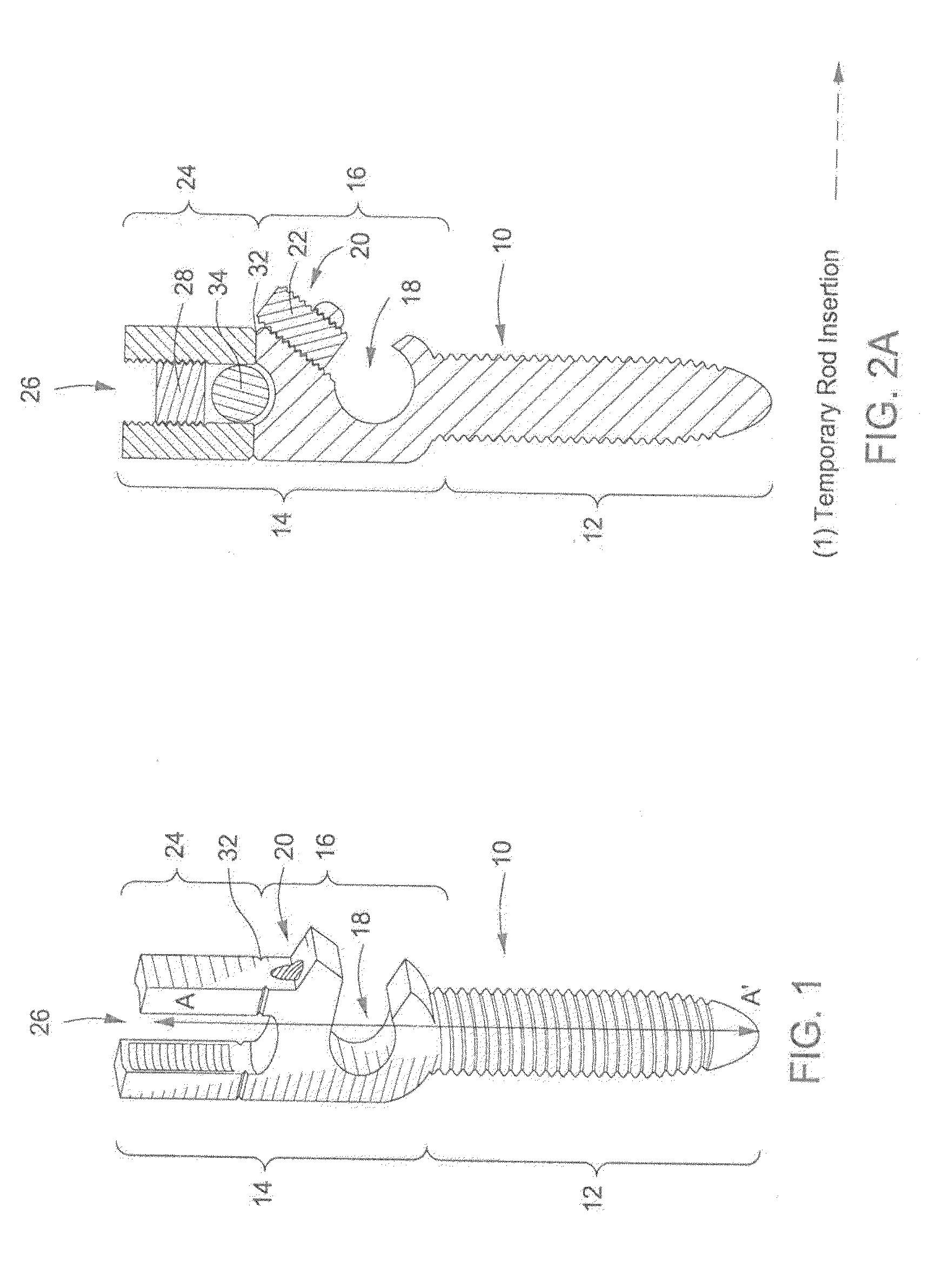 Pedicle Screw