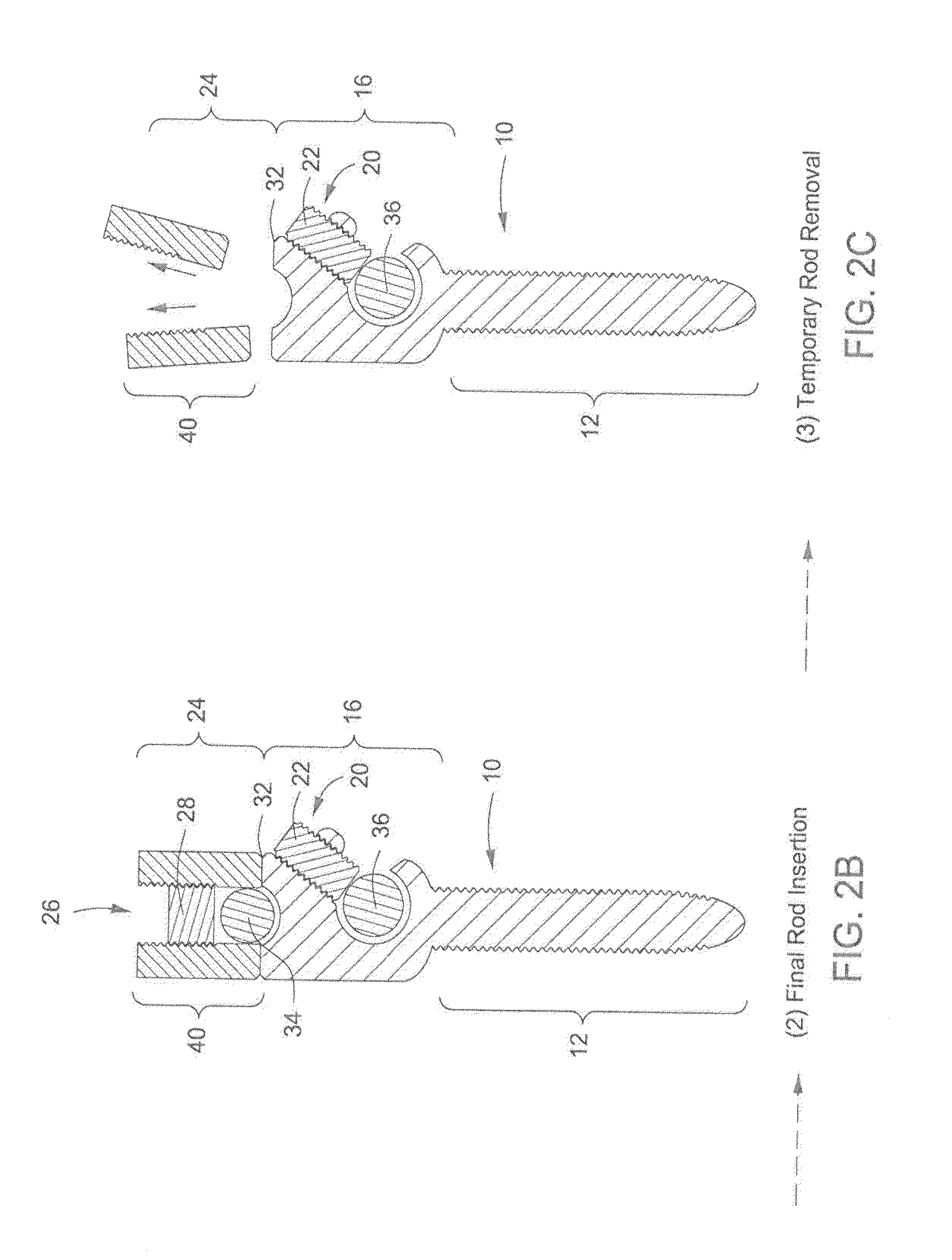 Pedicle Screw