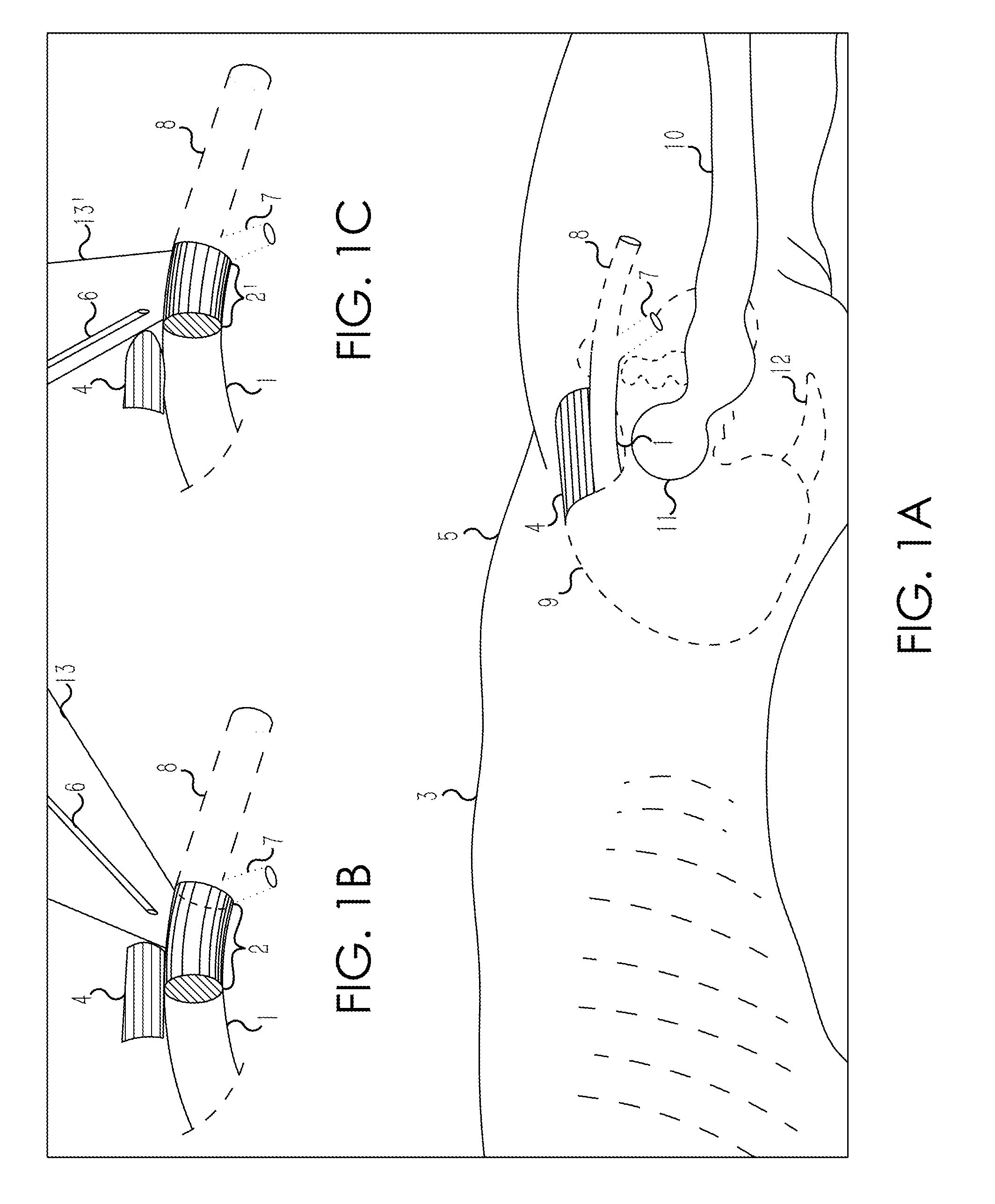 Retrograde entry antegrade placement for femoral artery access