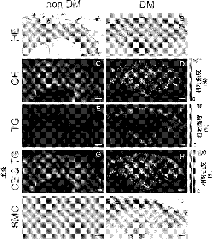 Prophylactic/therapeutic agent for cardiovascular complications of diabetes