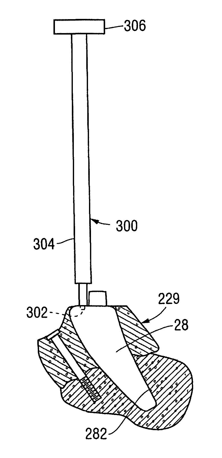 Total ankle replacement