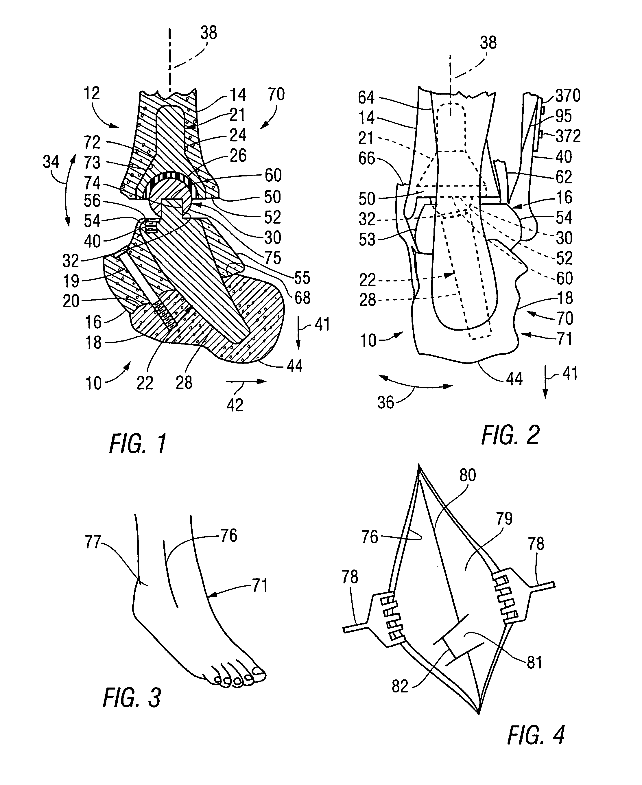 Total ankle replacement