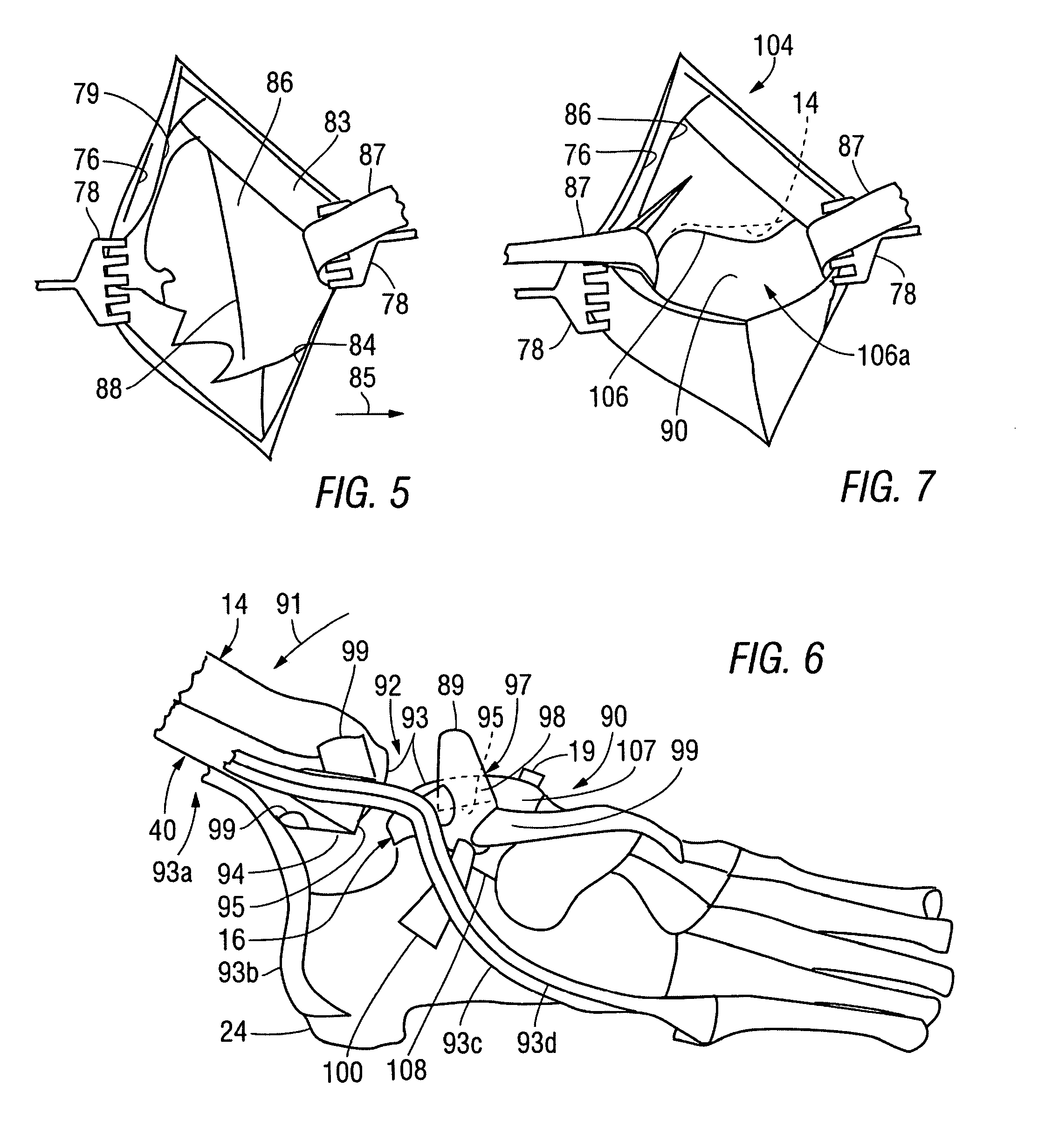 Total ankle replacement