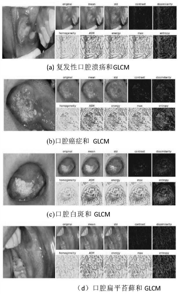 Oral mucosal disease recognition method based on deep learning multi-feature fusion