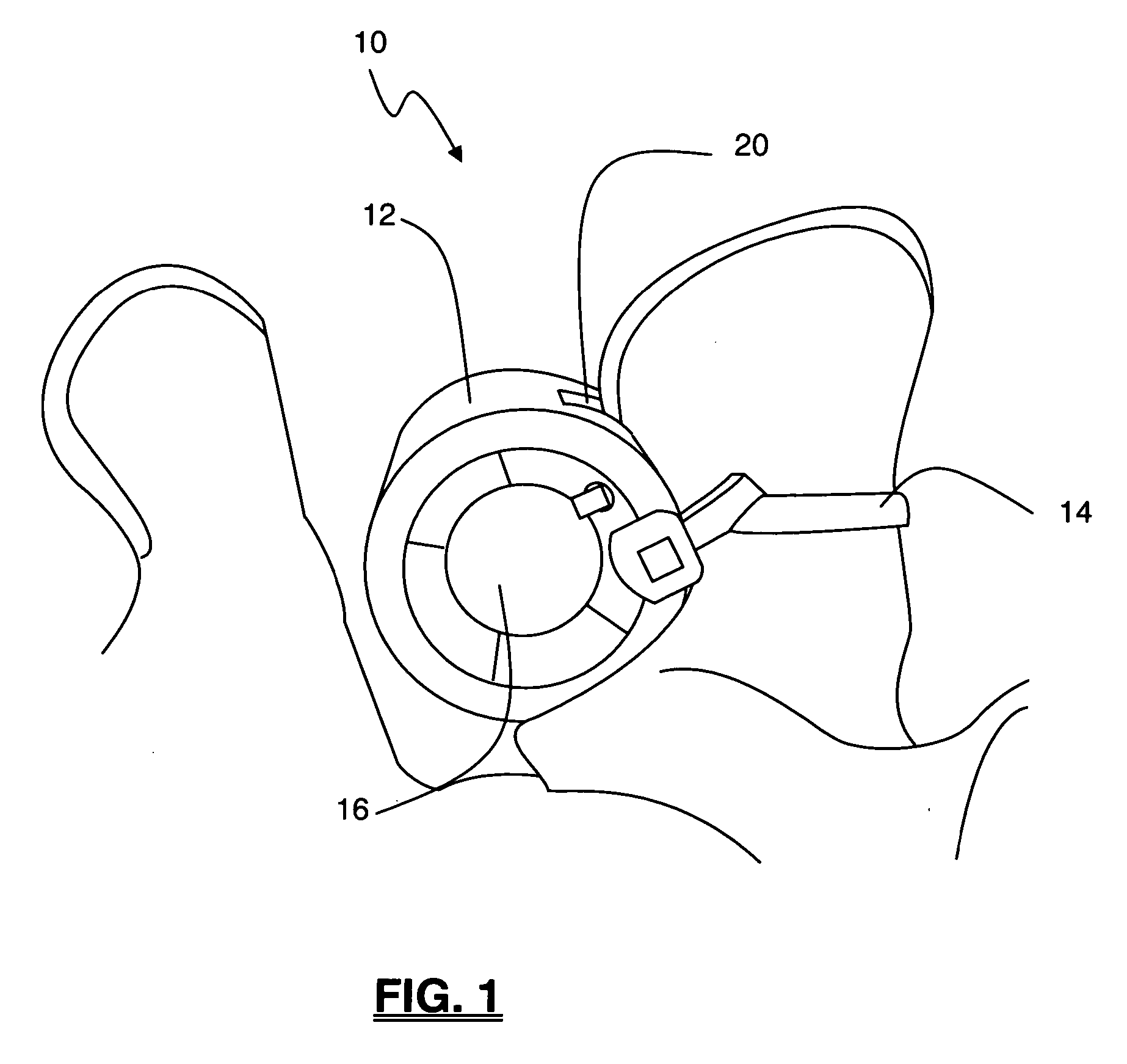 Methods and apparatus for treating spinal stenosis