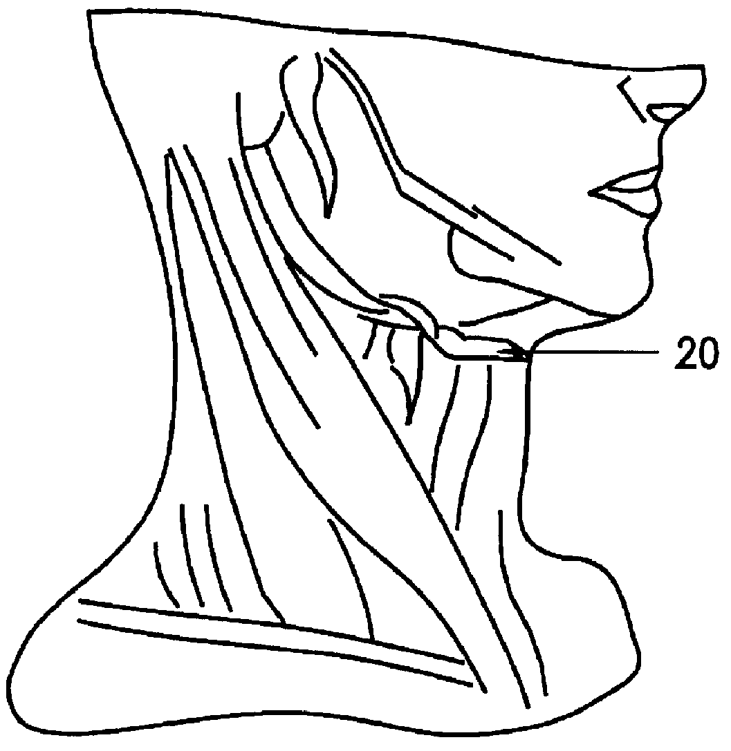 Hyoid expansion and suspension procedure