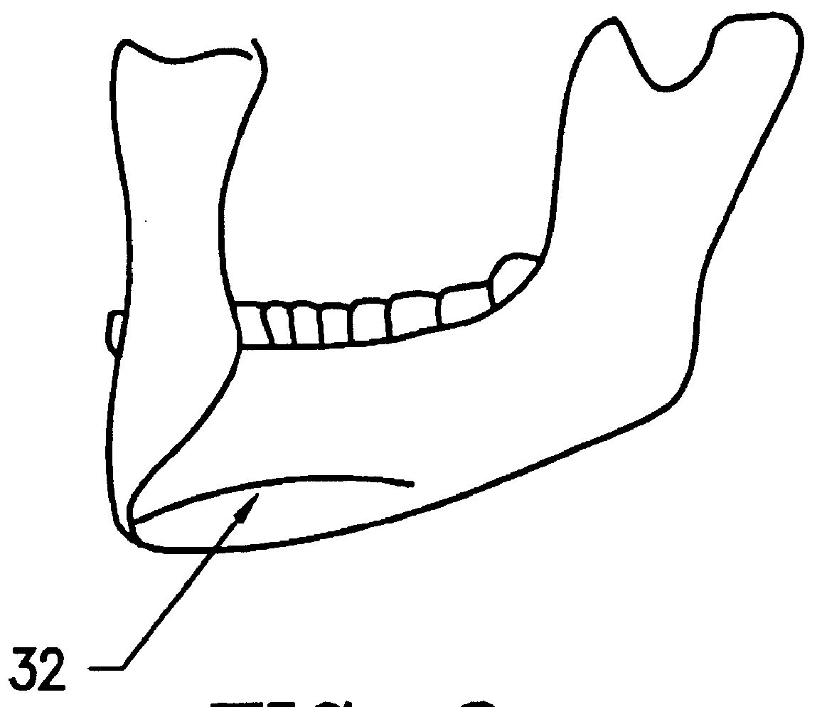 Hyoid expansion and suspension procedure