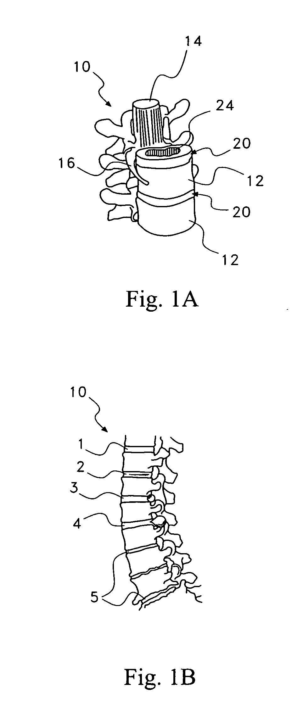 Pharmaceutical removal of vascular and/or neuronal extensions form a degenerating disc