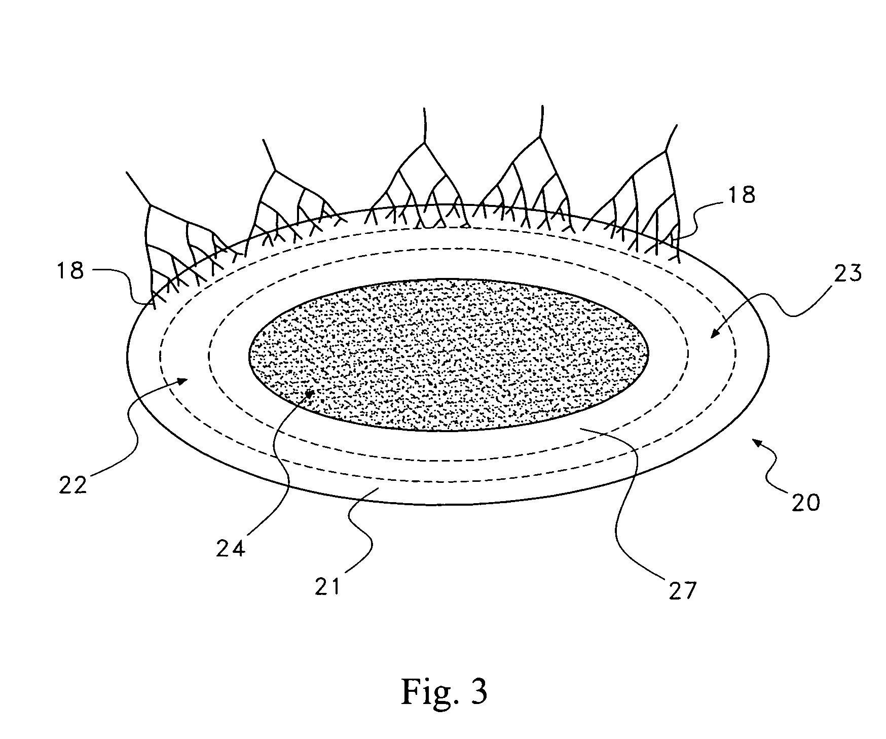 Pharmaceutical removal of vascular and/or neuronal extensions form a degenerating disc