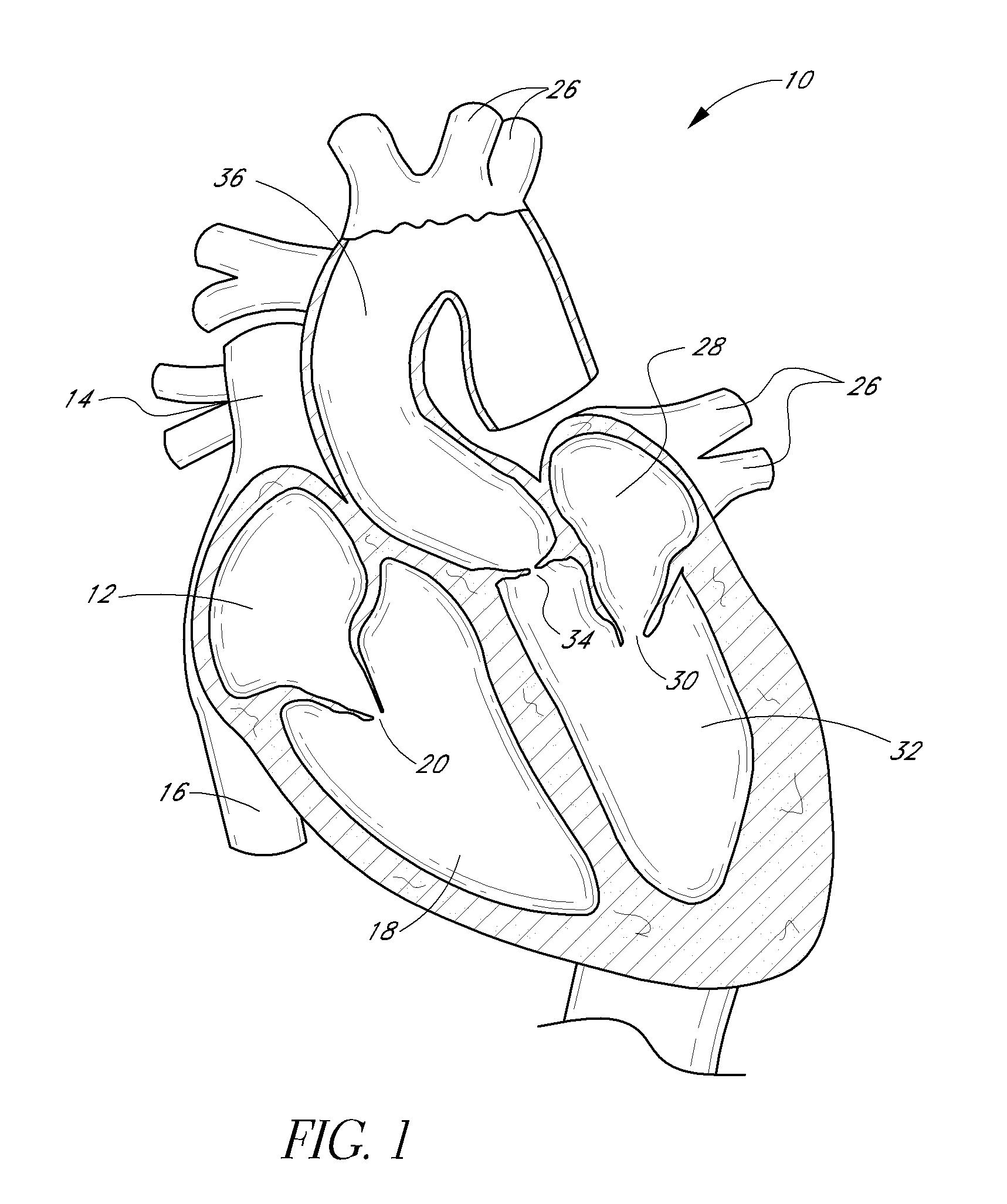 Translumenally implantable heart valve with formed in place support