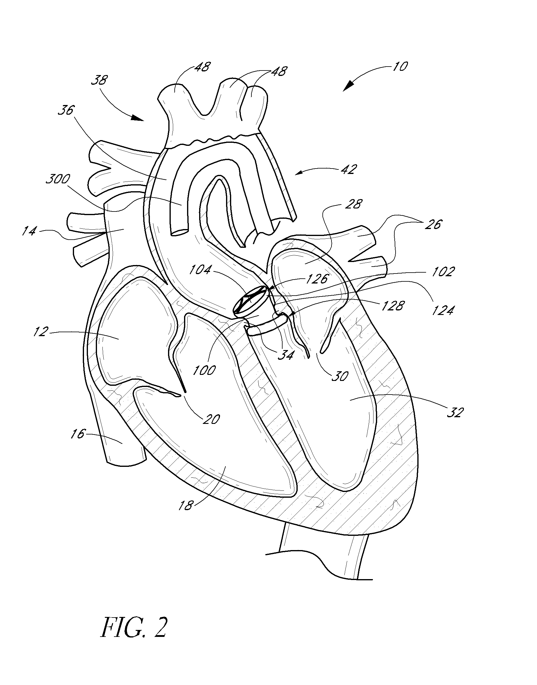 Translumenally implantable heart valve with formed in place support