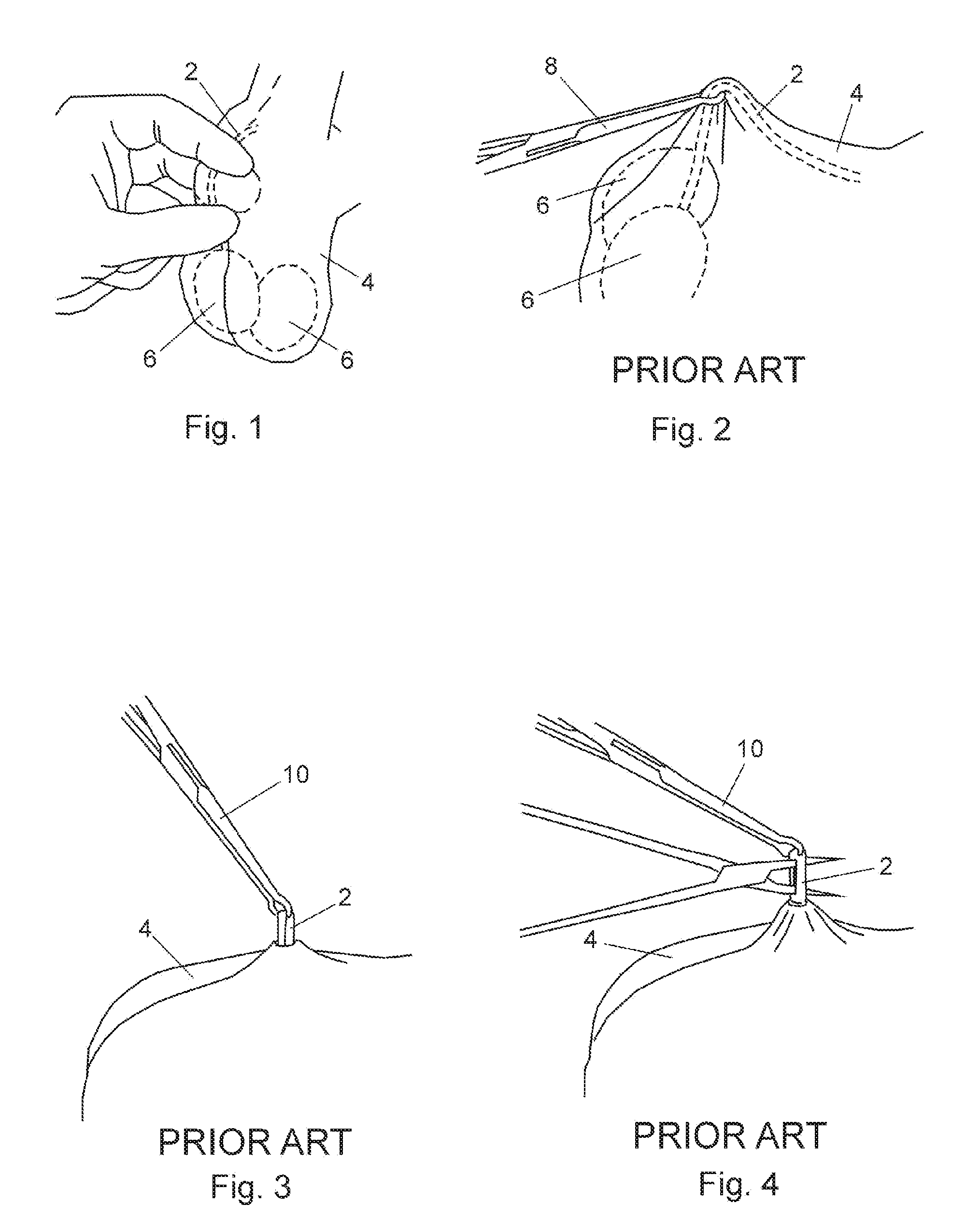 Vasectomy Devices and Kit and Method of Use