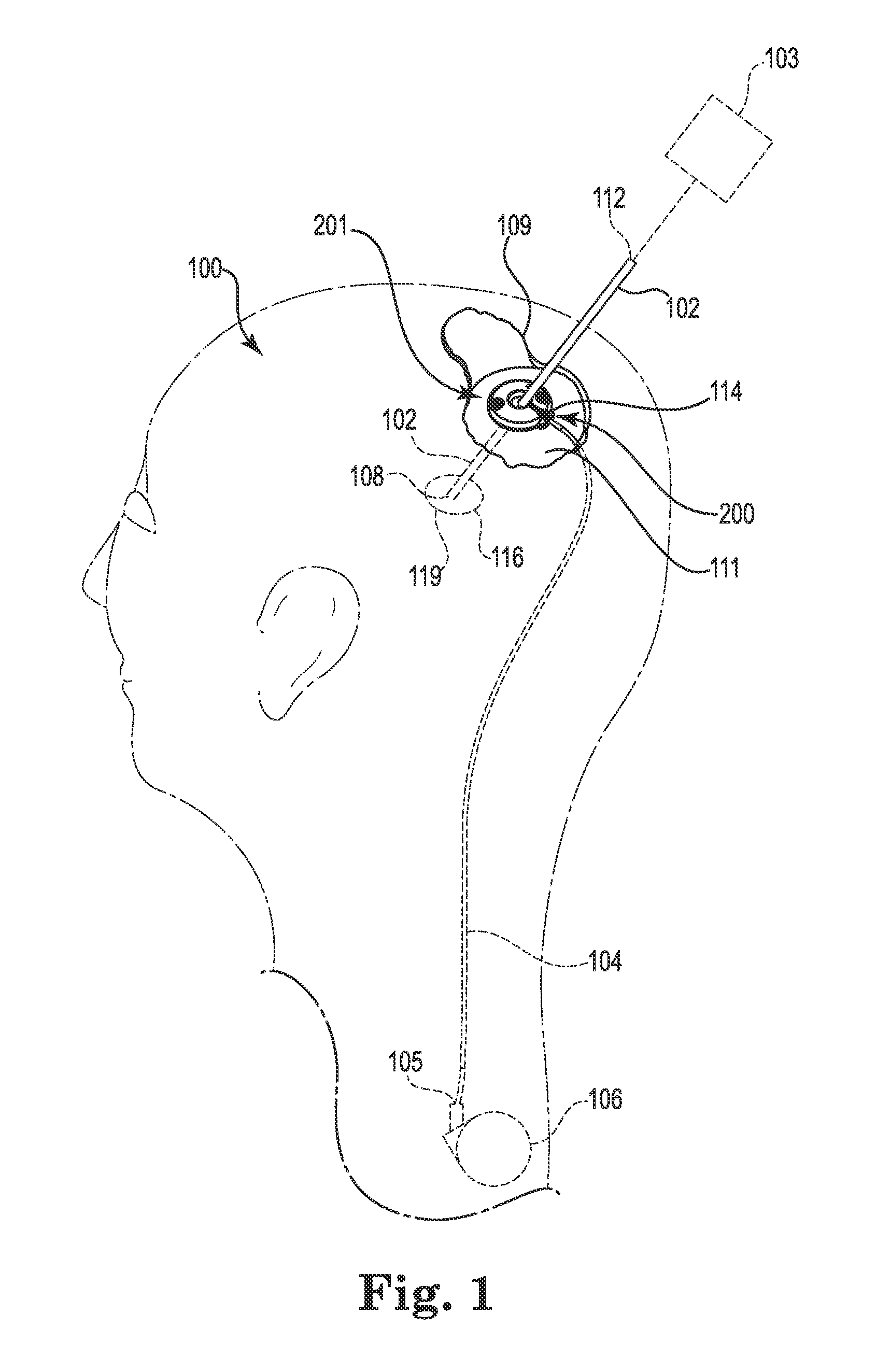 Socketed Portal Anchors and Methods of Using Same