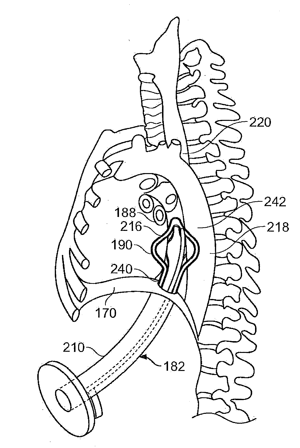 Diaphragm entry for posterior surgical access