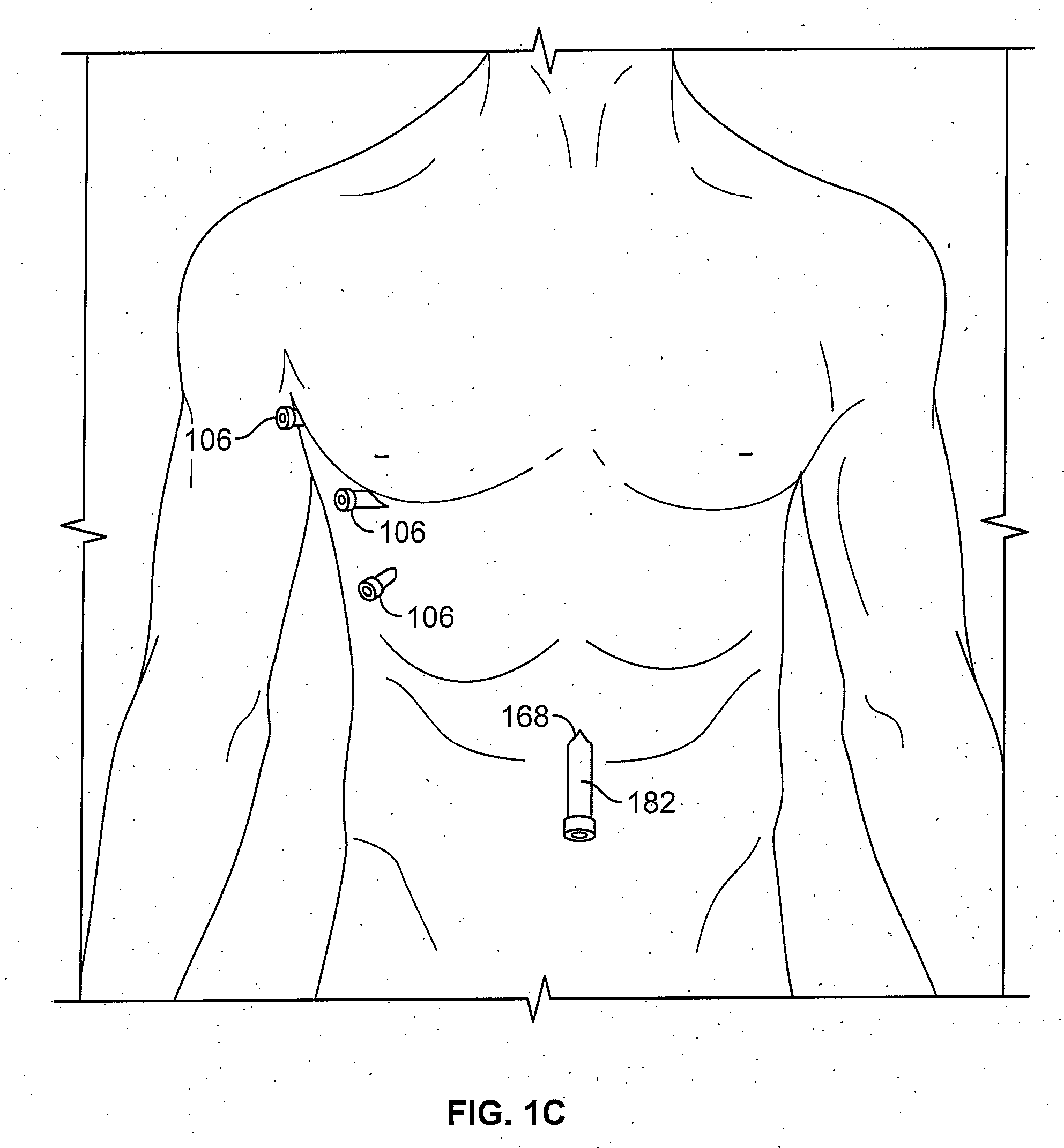 Diaphragm entry for posterior surgical access