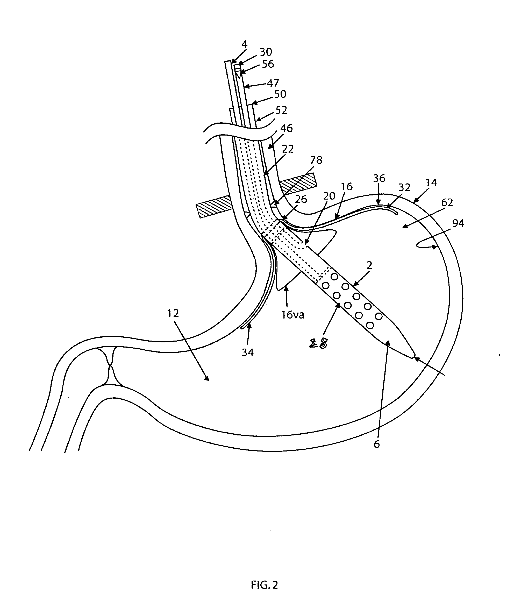 Nasogastric tube anti aspiration device