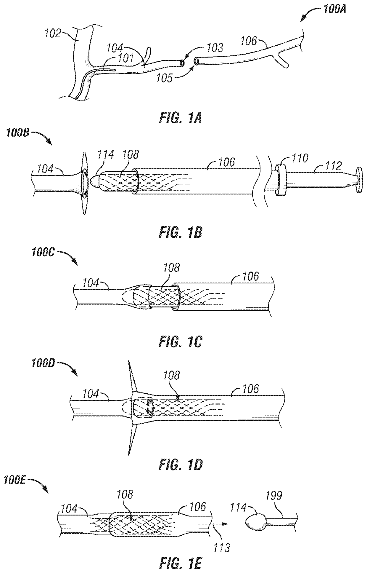 Stent delivery for vascular surgery