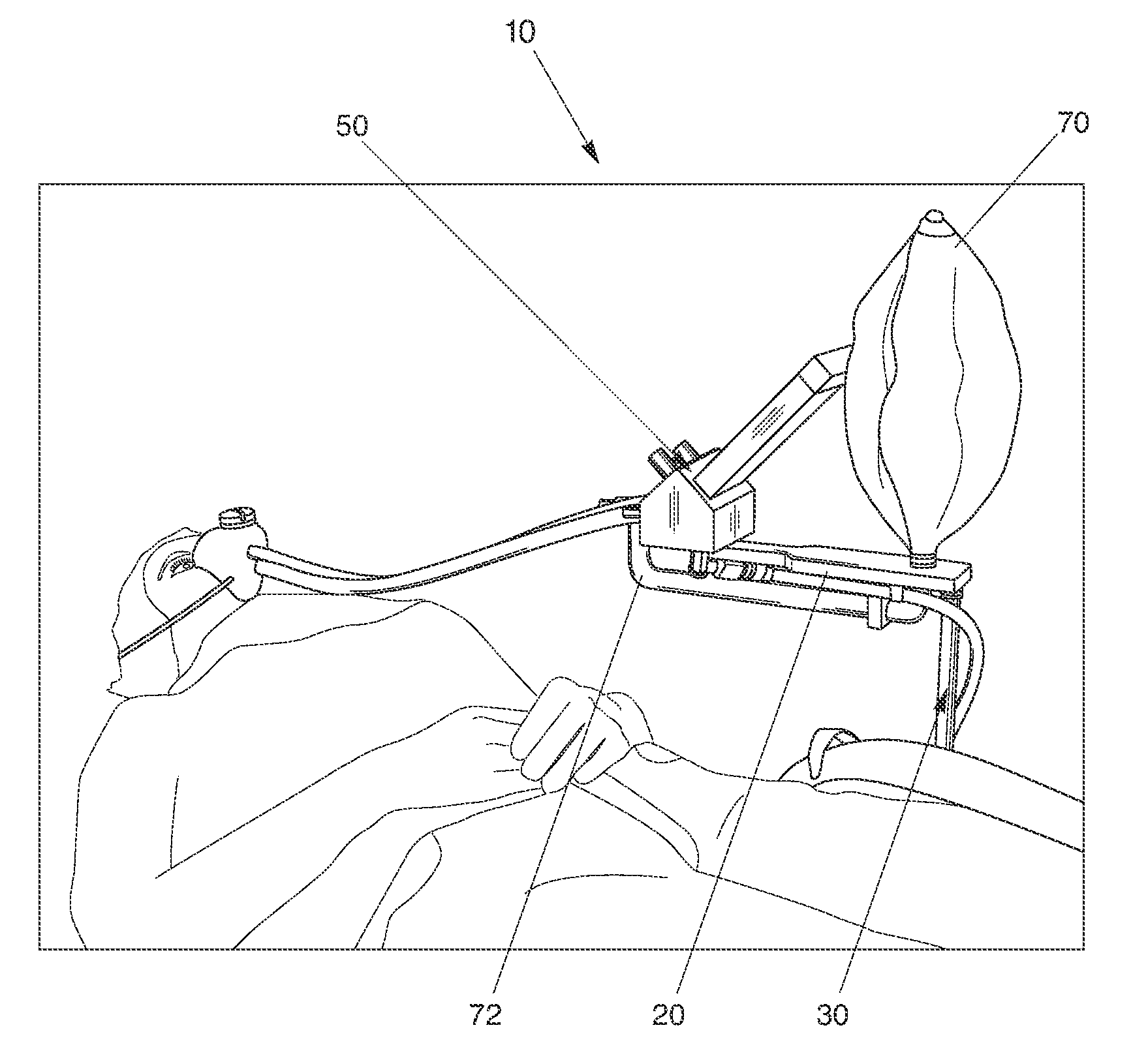 Nitrous Oxide Anesthetic Administration System