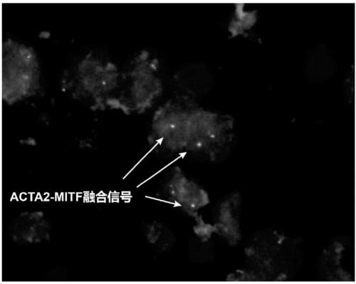 Probe assembly for diagnosing ACTA2-MITF translocation perivascular epithelioid cell tumor and application thereof