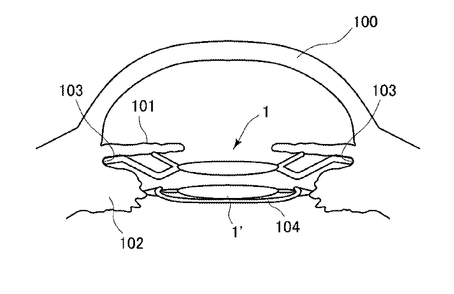 Intraocular lens