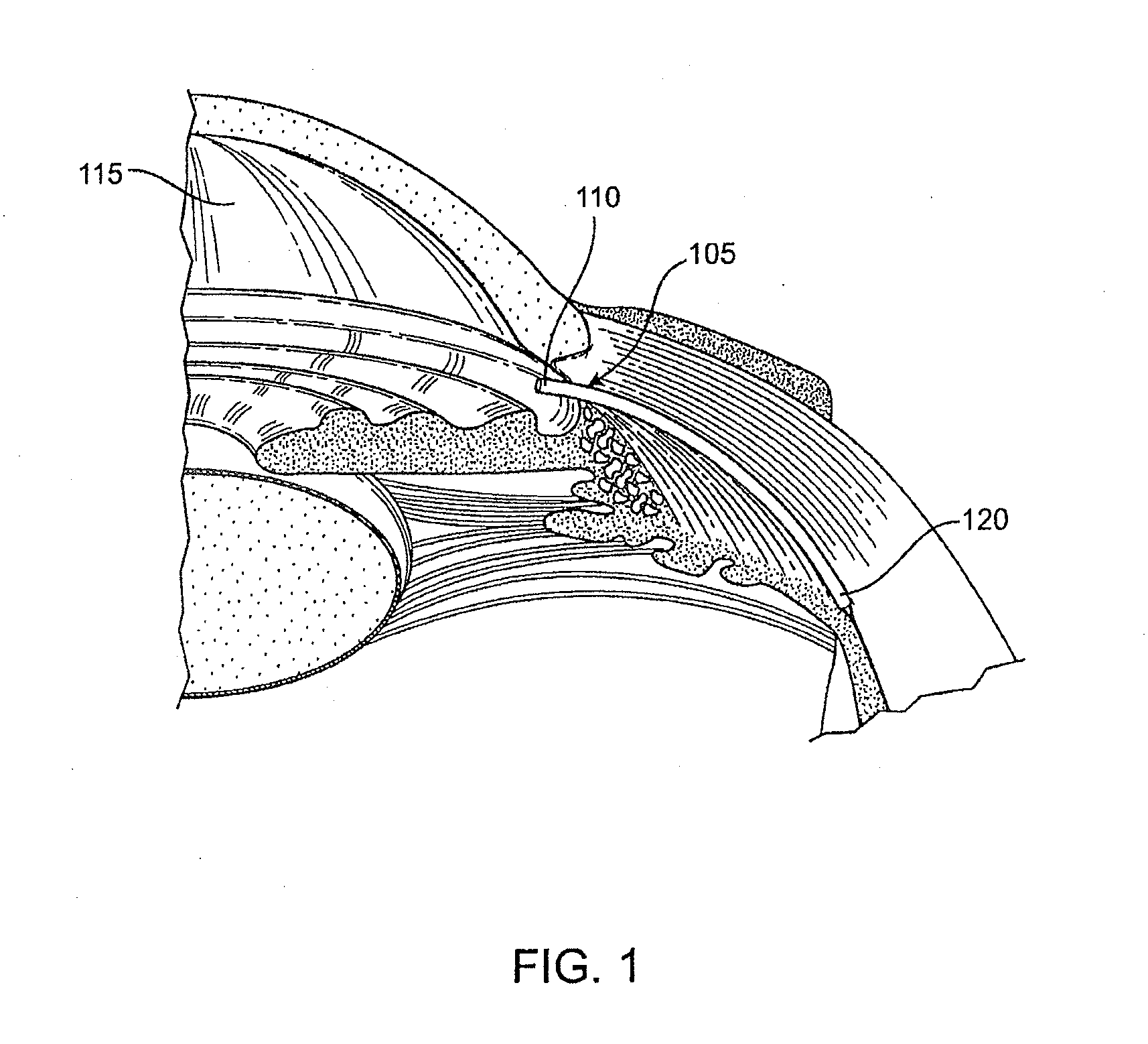 Glaucoma Treatment Device