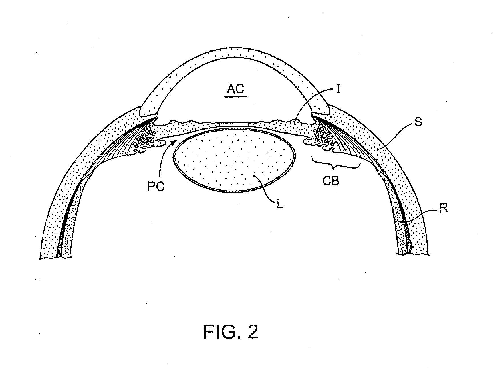 Glaucoma Treatment Device