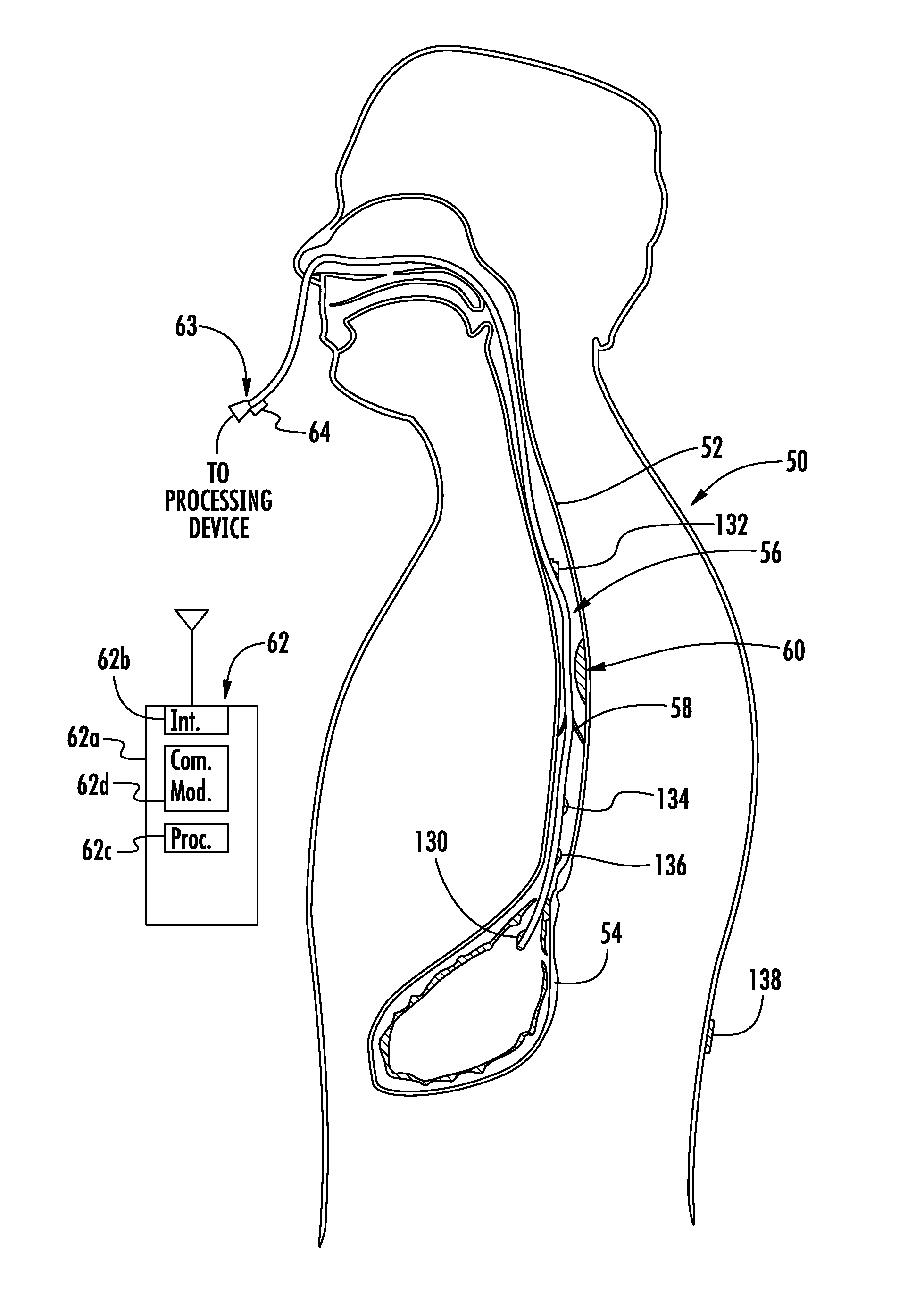 Device with passive valve to block emesis and/or reflux and associated system and method