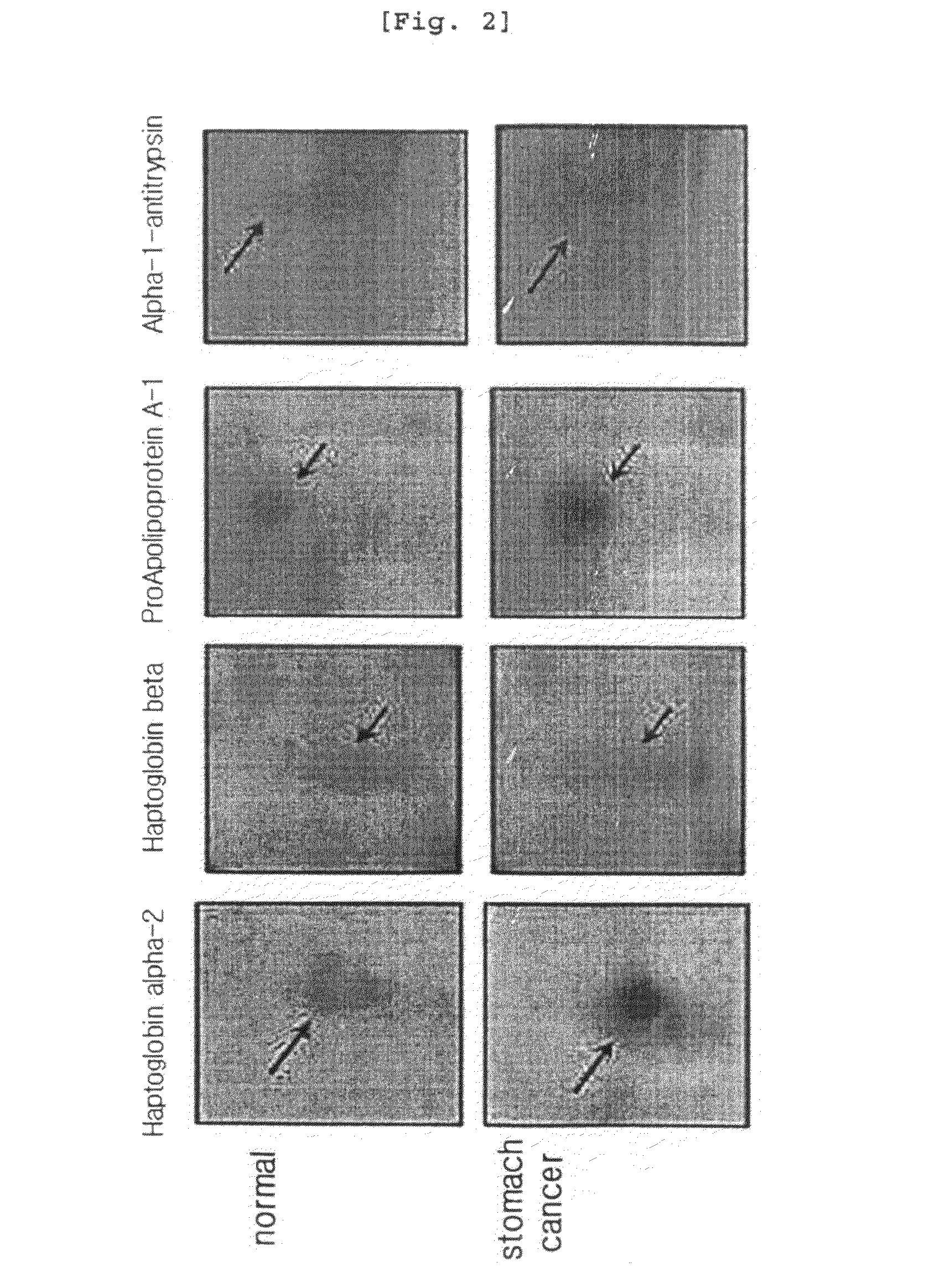 Protein markers for diagnosing stomach cancer and the diagnostic kit using them